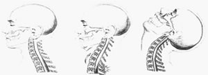 whiplash movement pattern